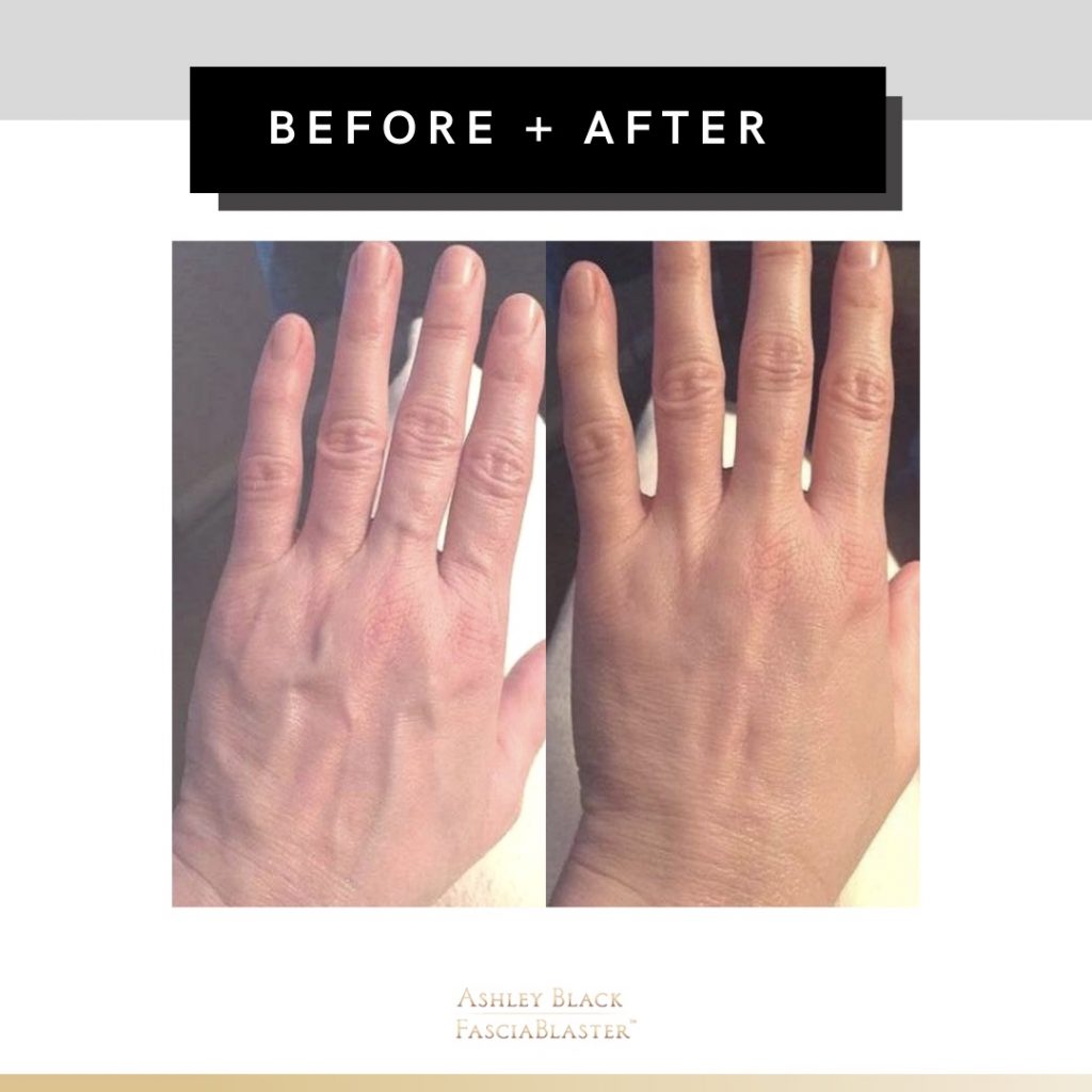 Manchester New Hampshire Spa Fascia Hands Before After 1024x1024